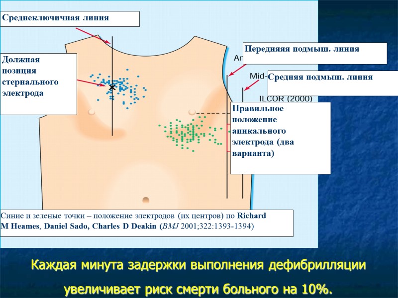 Каждая минута задержки выполнения дефибрилляции увеличивает риск смерти больного на 10%.